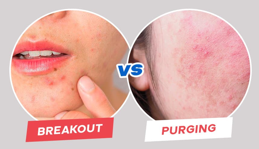 Perbedaan Purging dan Breakout: Cara Mengenali Reaksi Kulit Saat Pakai Skincare
