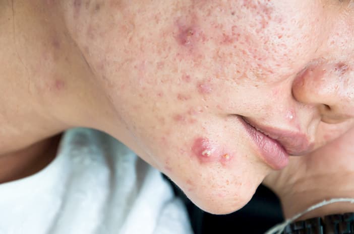 Jerawat Kistik (Cystic Acne): Penyebab, Ciri-Ciri, dan Cara Mengatasinya