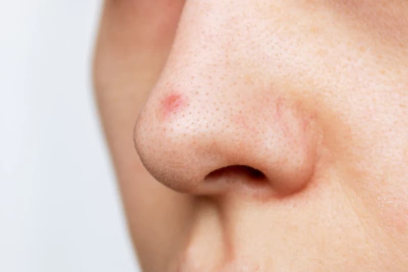 Jerawat di Hidung: Penyebab dan Cara Mengatasinya
