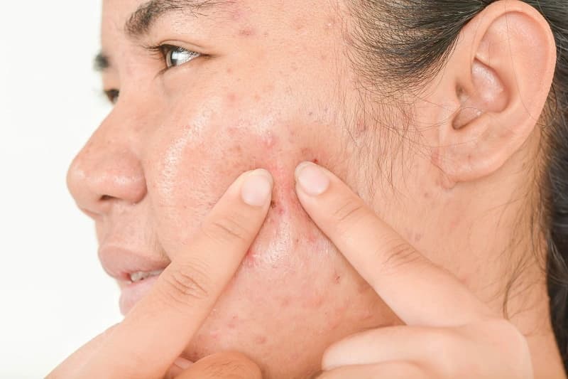 Cara Mengurangi Jerawat di Wajah dengan Cara Sederhana
