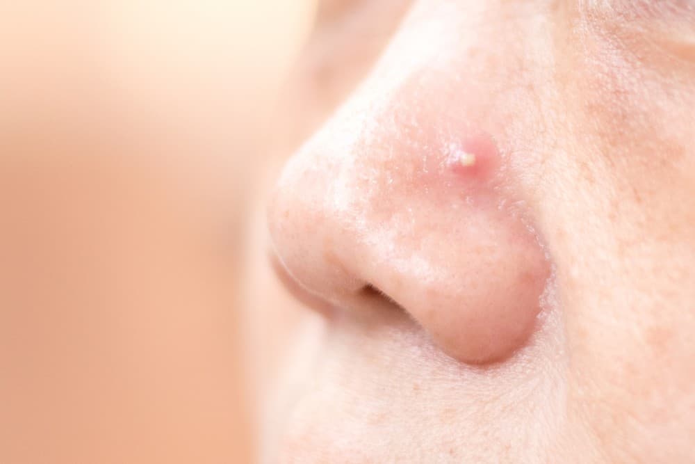 Cara Mengatasi Jerawat di Hidung yang Sakit