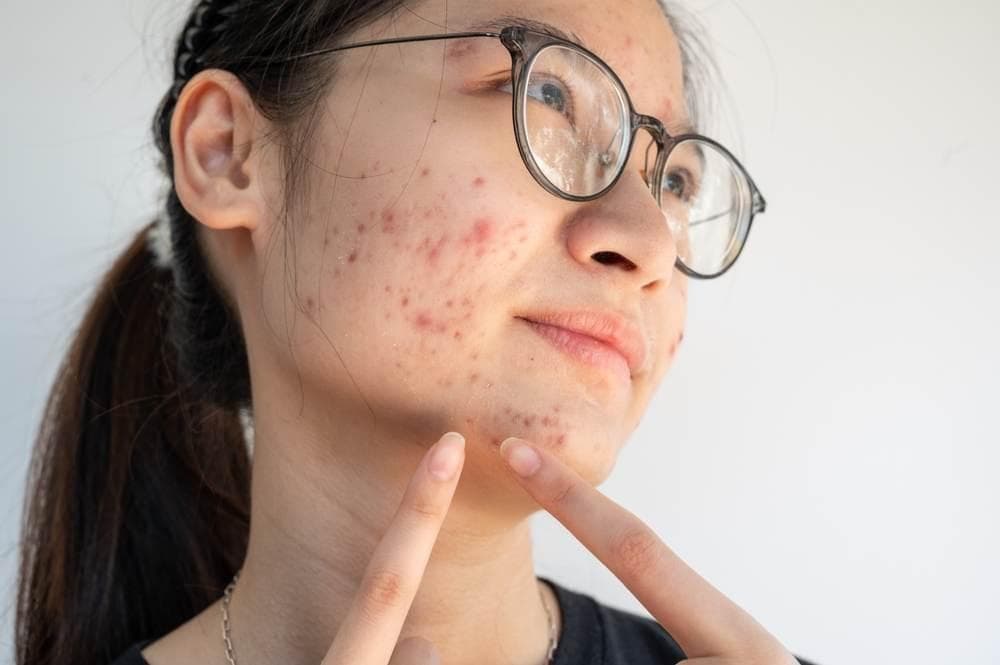 Cara Menghilangkan Bekas Jerawat Hitam di Pipi