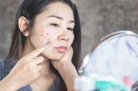 Cara Menghilangkan Noda Hitam Bekas Jerawat