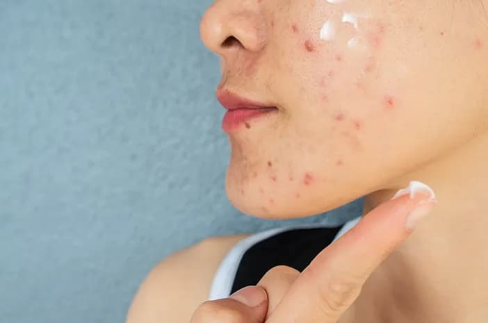 Skincare untuk Jerawat yang Direkomendasikan agar Kulit Lebih Sehat
