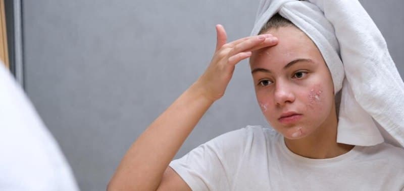 Skincare untuk Menghilangkan Jerawat dan Bekasnya agar Kulit Lebih Bersih