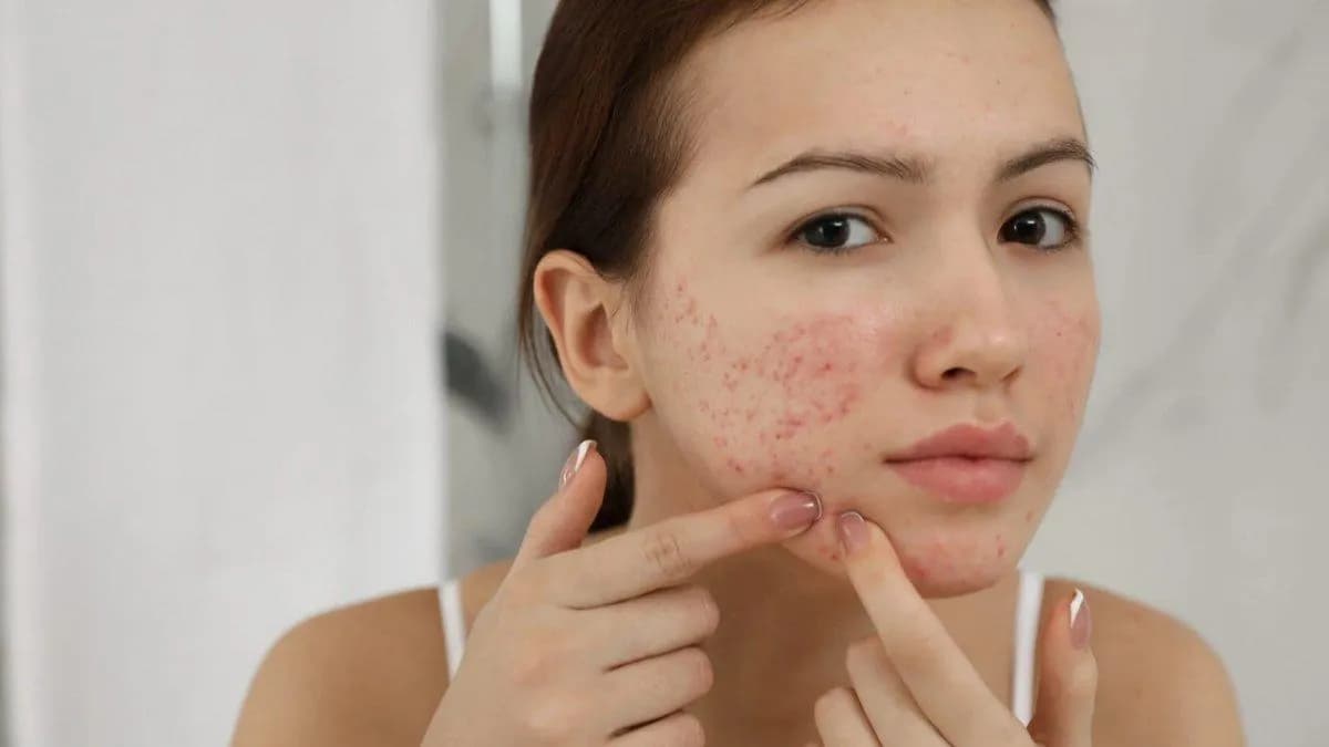 Skincare dengan Salicylic Acid untuk Jerawat: Kenapa Banyak Direkomendasikan?