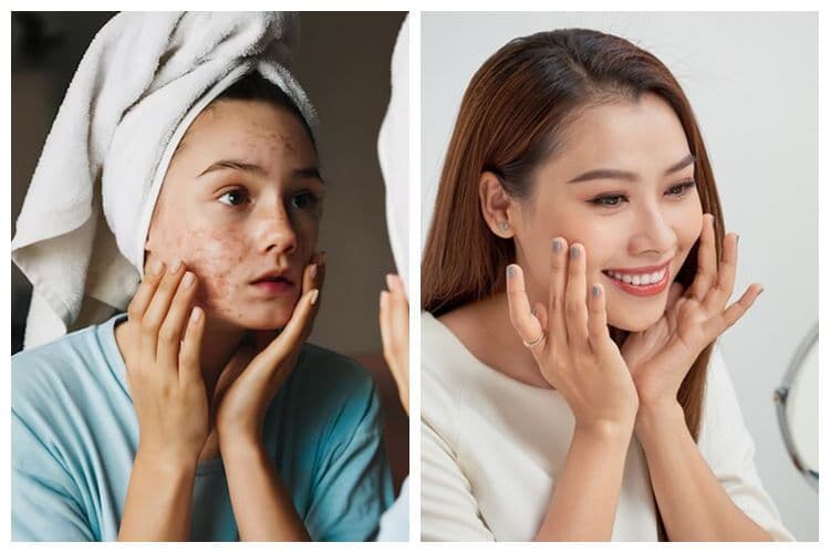 Kombinasi Kandungan Skincare untuk Jerawat yang Sering Digunakan