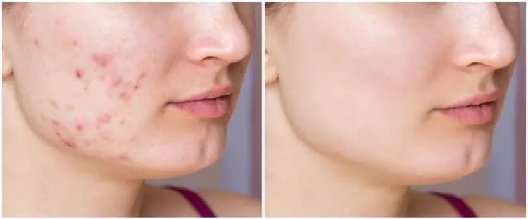 Kombinasi Kandungan Skincare untuk Bekas Jerawat yang Sering Digunakan