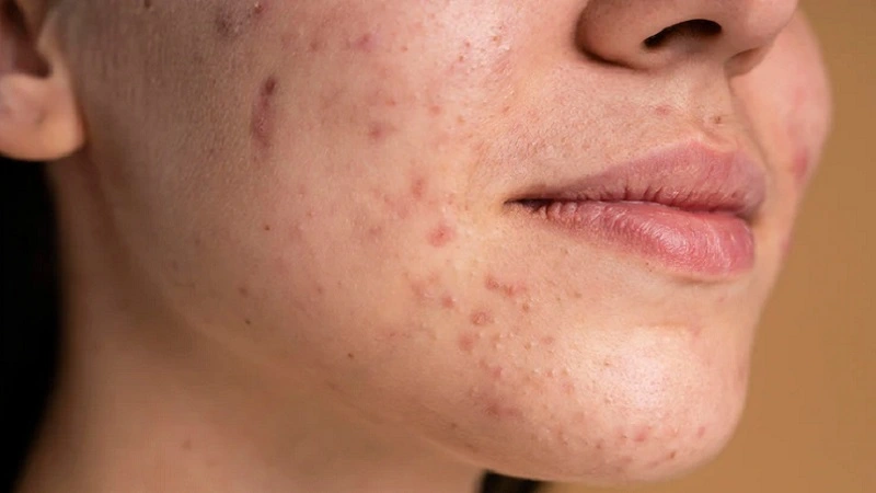 Bekas Jerawat: Penyebab dan Cara Menghilangkannya Bekas Jerawat: Penyebab dan Cara Menghilangkannya