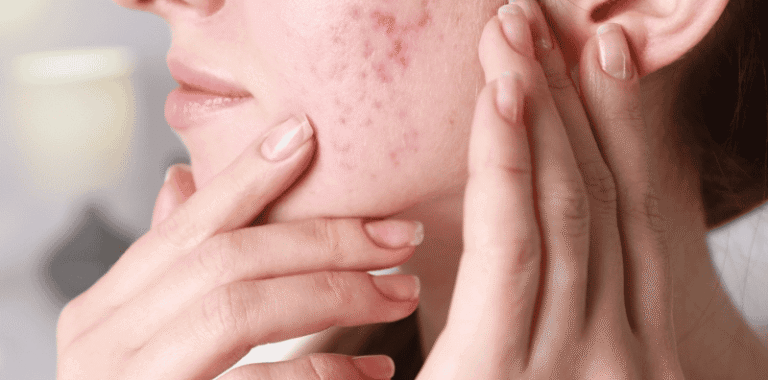 Cara Menghilangkan Bekas Jerawat yang Menghitam