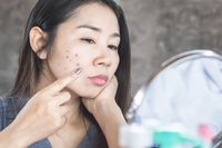 Cara Menghilangkan Noda Hitam Bekas Jerawat