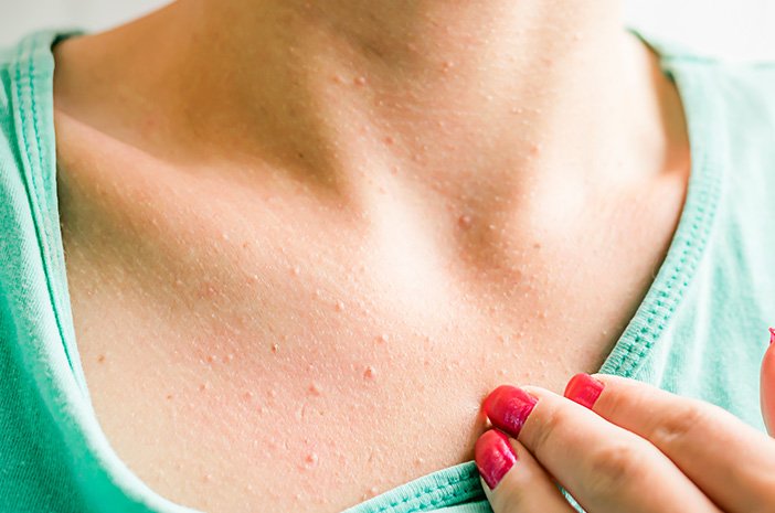 Jerawat di Dada: Penyebab dan Cara Mengatasinya Jerawat di Dada: Penyebab dan Cara Mengatasinya