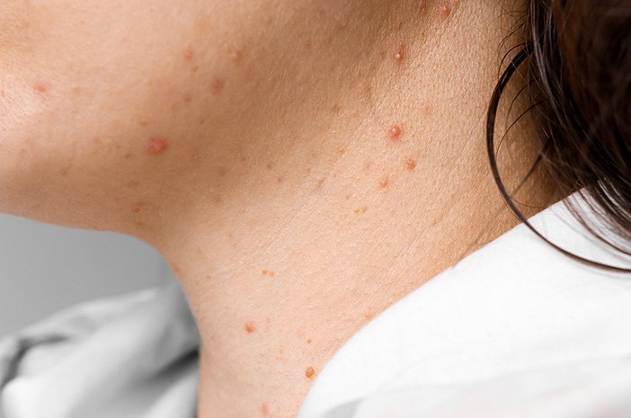 Jerawat di Leher: Penyebab dan Cara Mengatasinya Jerawat di Leher: Penyebab dan Cara Mengatasinya