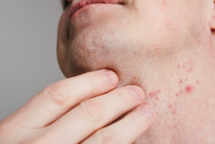 Jerawat di Rahang: Penyebab dan Cara Mengatasinya Jerawat di Rahang: Penyebab dan Cara Mengatasinya