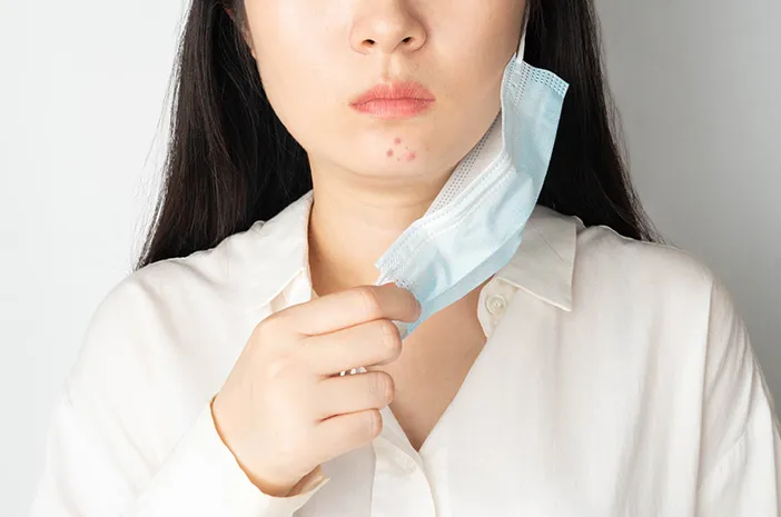 Cara Mengatasi Jerawat Hormon di Dagu Cara Mengatasi Jerawat Hormon di Dagu