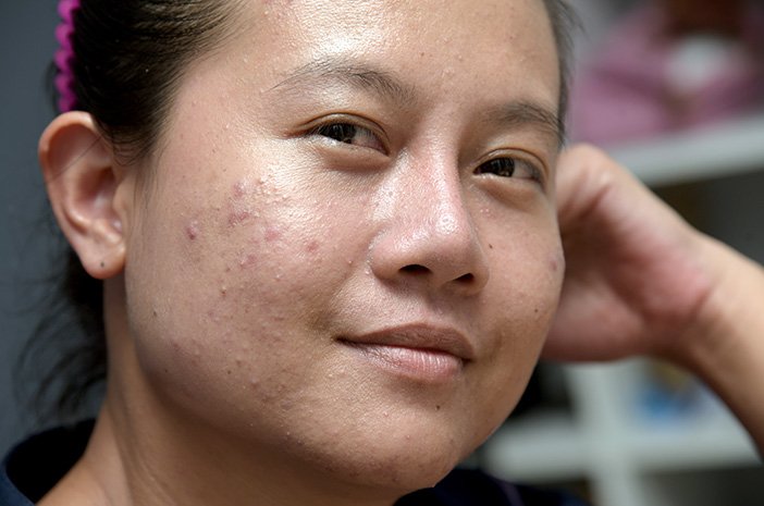 Jerawat Pasir: Penyebab, Ciri-Ciri, dan Cara Menghilangkannya Jerawat Pasir: Penyebab, Ciri-Ciri, dan Cara Menghilangkannya